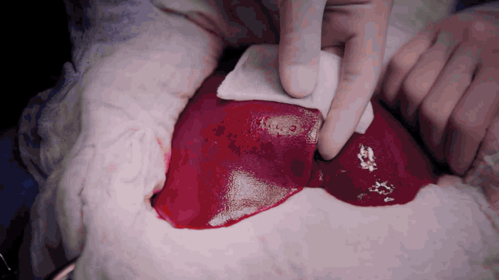 GIF of a Grade 1 bleed in the OR according to the VIBe Scale.