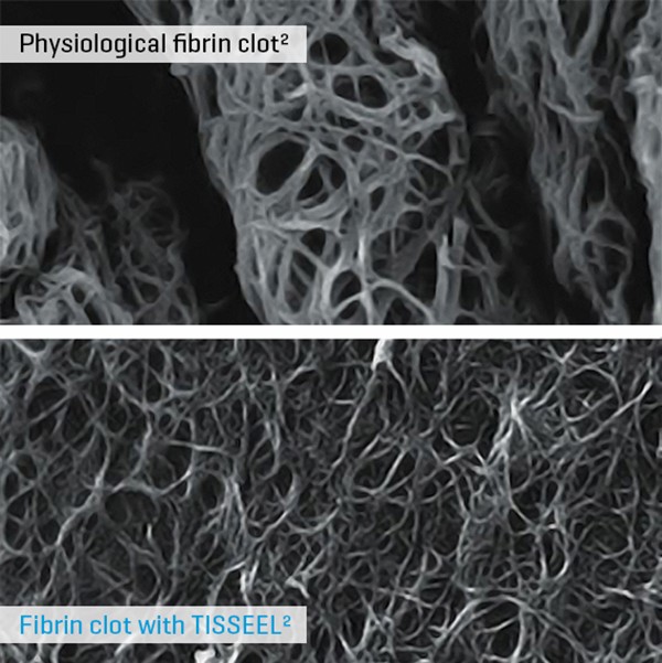Physiological fibrin clot vs Fibrin clot with TISSEEL