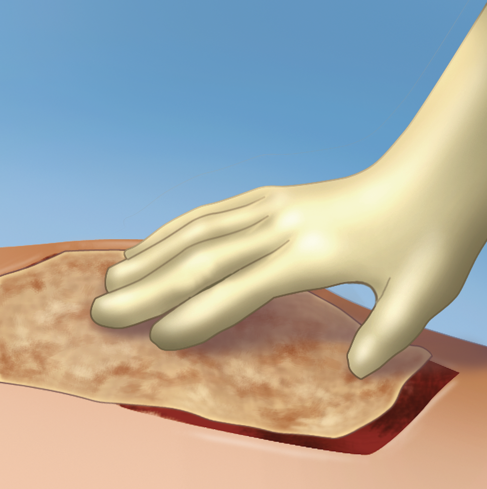 Skin graft placement