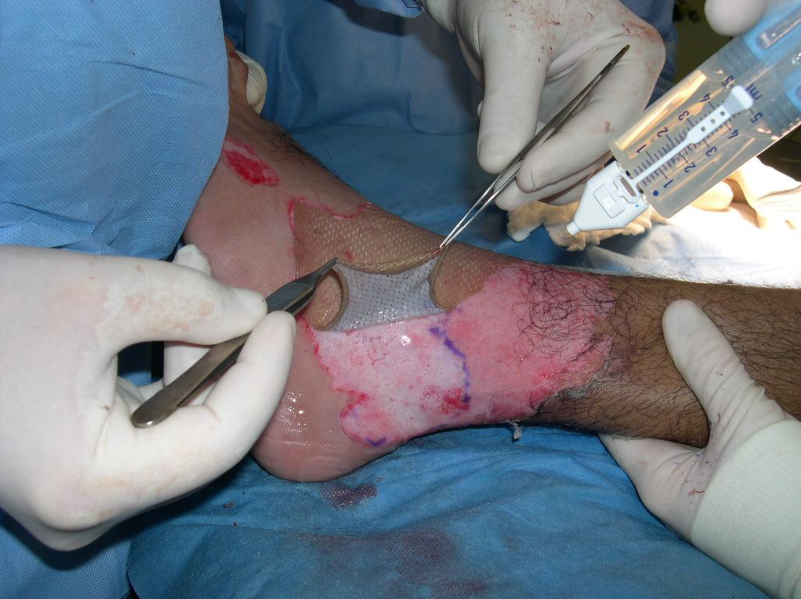 Split thickness skin graft being applied with Artiss 