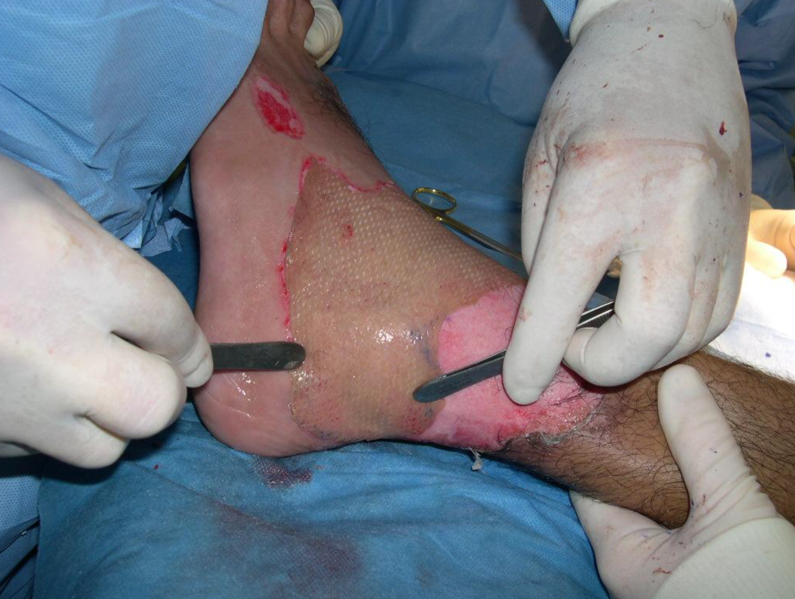 Graft is laid out flush with wound bed