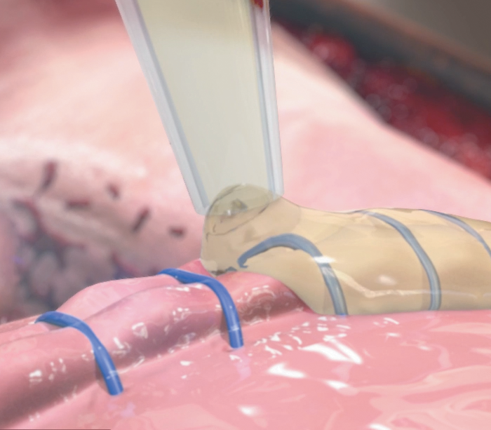 Preveleak applied to suture line