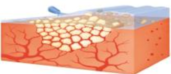 Once hemostasis is achieved, excess Floseal Matrix should always be removed by gentle irrigation and suctioned out of the wound.